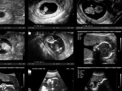 做试管婴儿有哪些基本要求(做试管婴儿对卵泡的要求是什么)